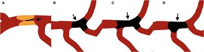 Jet-Like Appearance in Angiography as a Predictive Image Marker for the Occlusion of Intracranial Atherosclerotic Stenosis